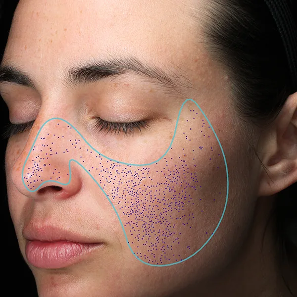 VISIA® Analyse: Poren – Größe und Verteilung