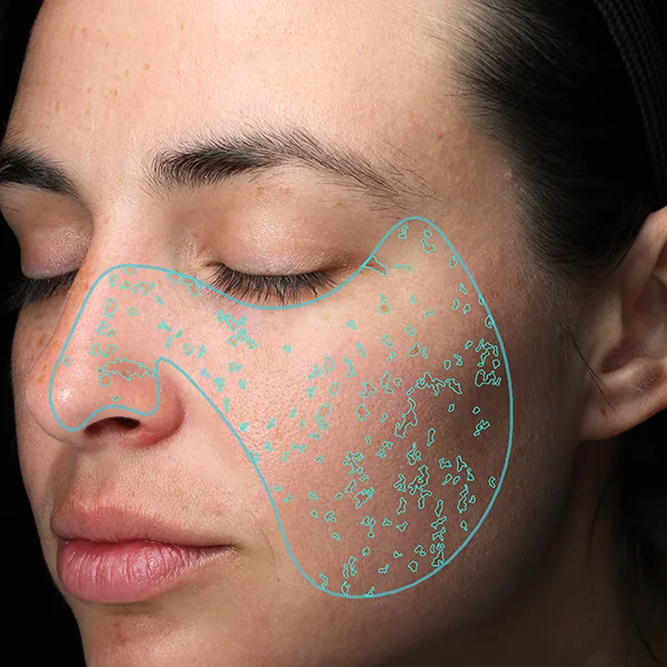 VISIA® Analyse: Spots – Erkennung von Pigmentflecken