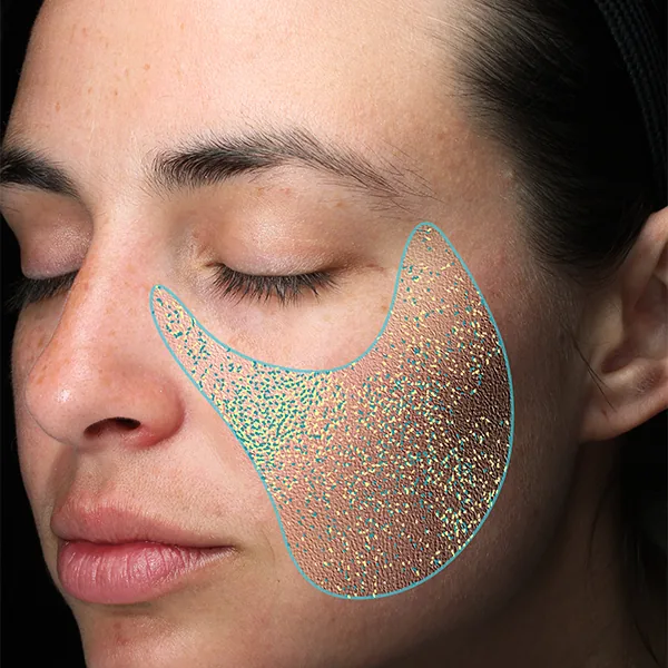VISIA® Analyse: Textur – Hautoberfläche und Unregelmäßigkeiten
