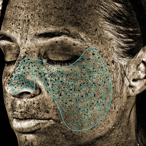 VISIA® Analyse: UV-Spots – UV-induzierte Pigmentveränderungen